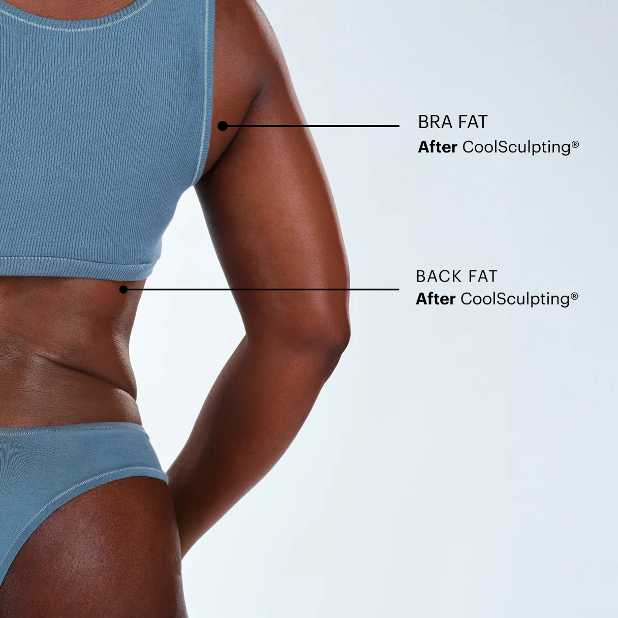 Can CoolSculpting® reduce my back fat and bra bulge permanently?