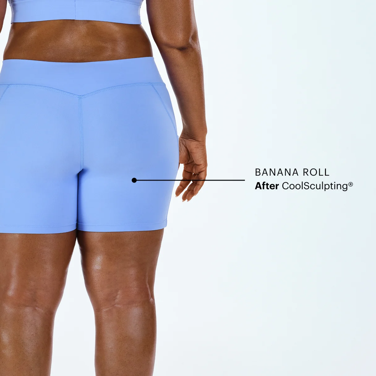 What is a banana roll—and can CoolSculpting® help?