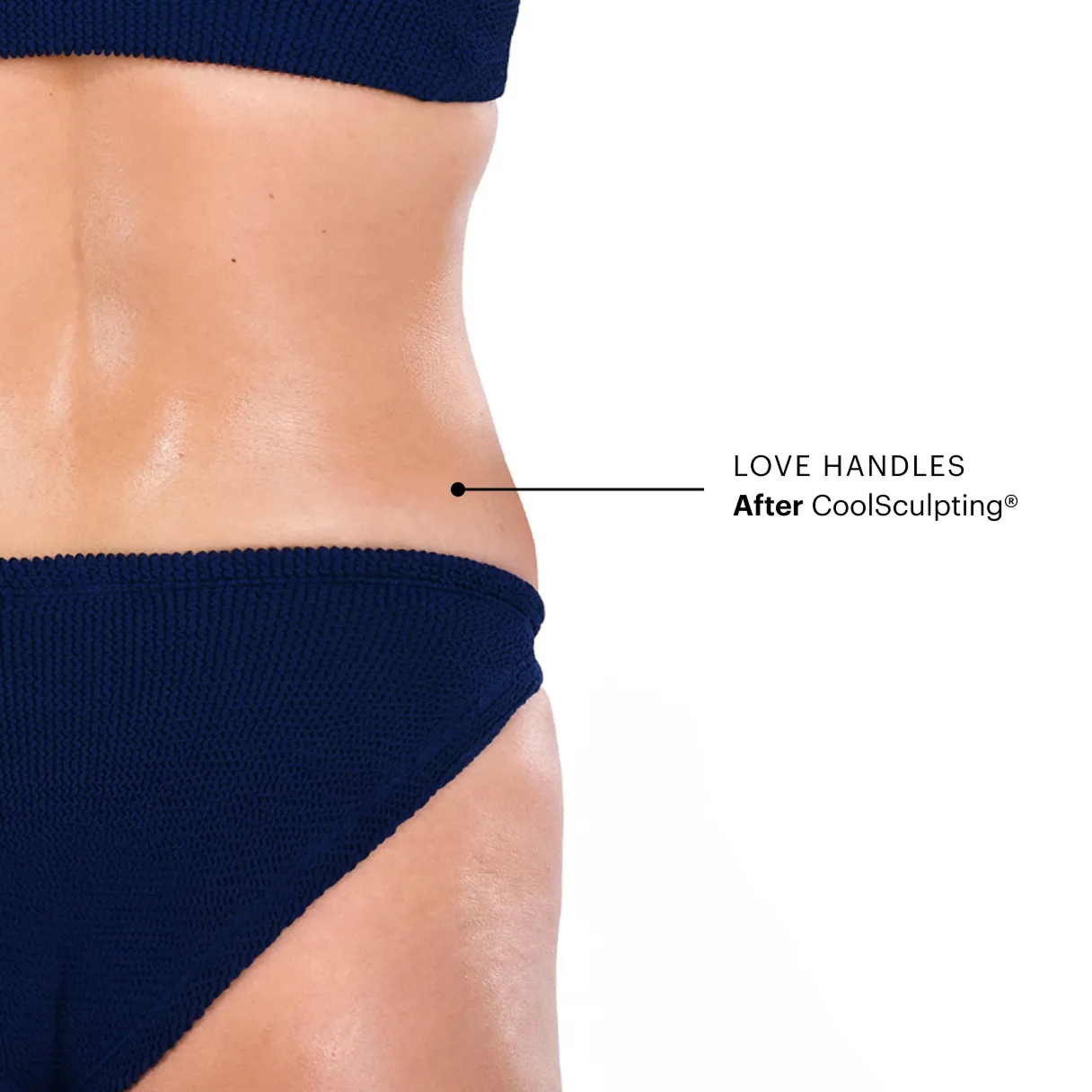 Can CoolSculpting® get rid of love handles?