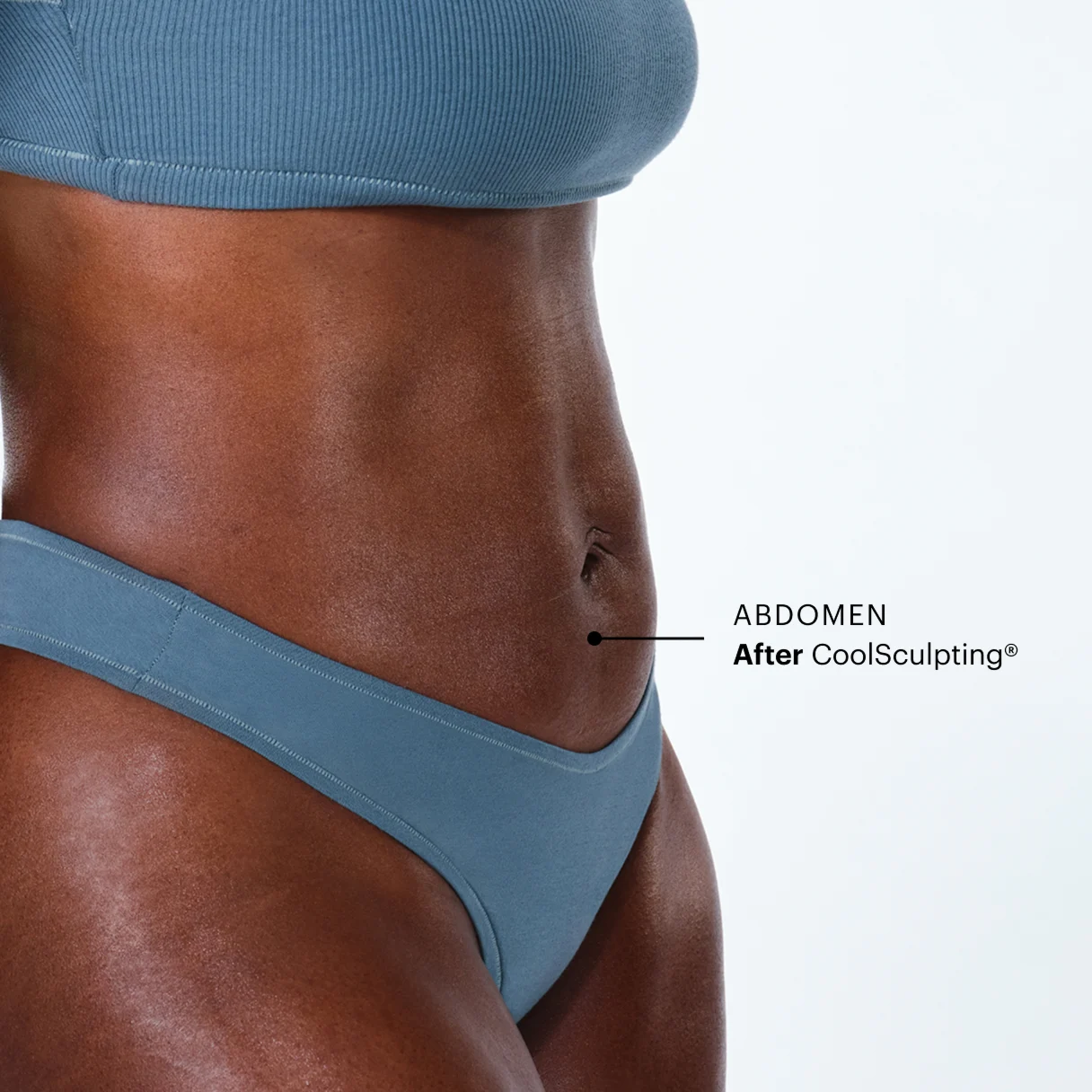 How is CoolSculpting® different from liposuction?