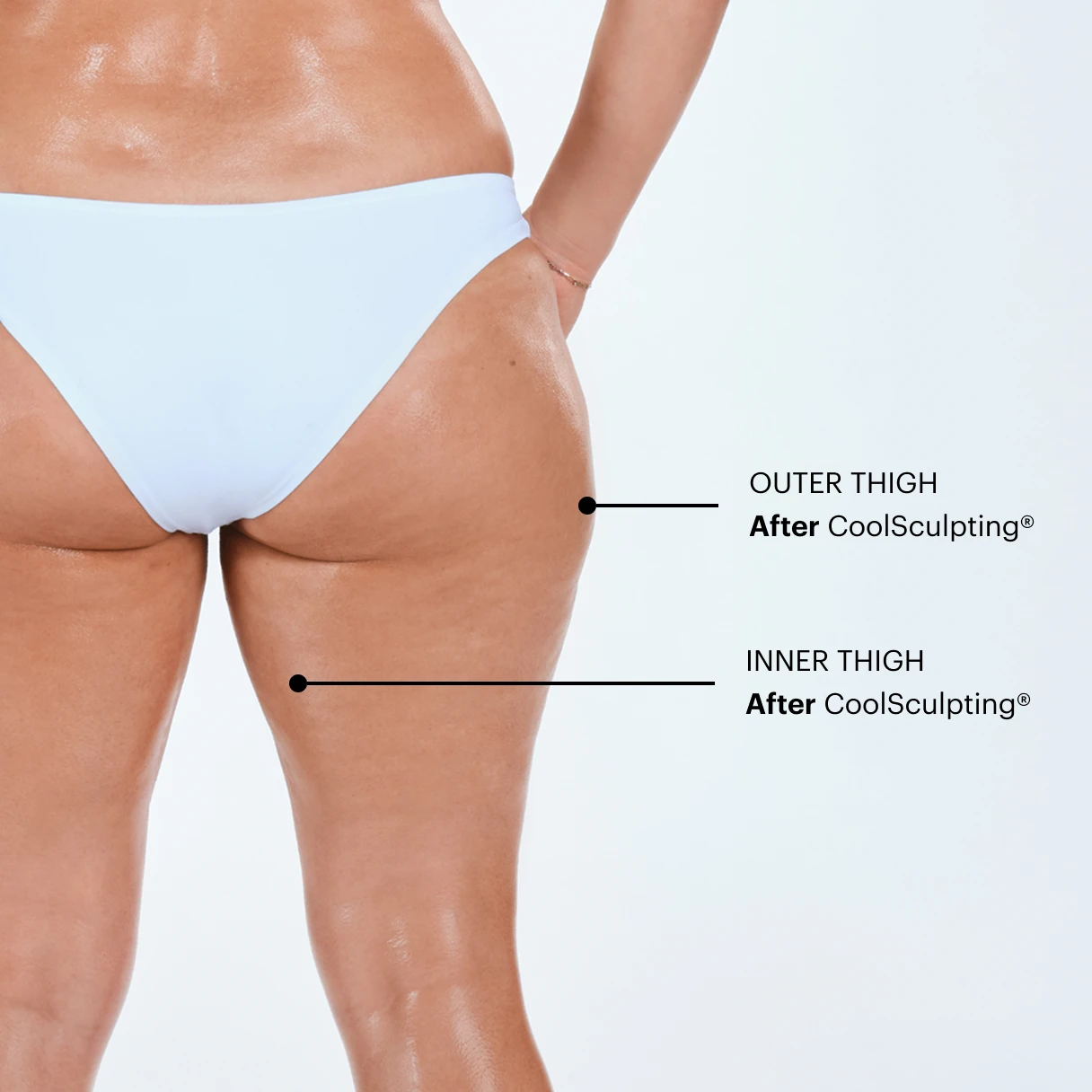 Can CoolSculpting® remove cellulite from thighs? 